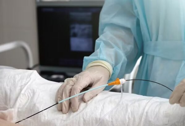 Ablação: entenda o procedimento utilizado para tratar arritmia de Caiado